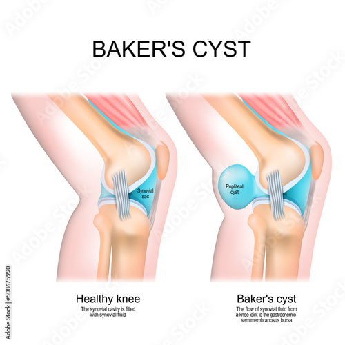 Baker's cyst. Normal knee, and joint with Popliteal cyst photo