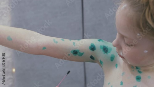 lubricate sores with green paint during chickenpox