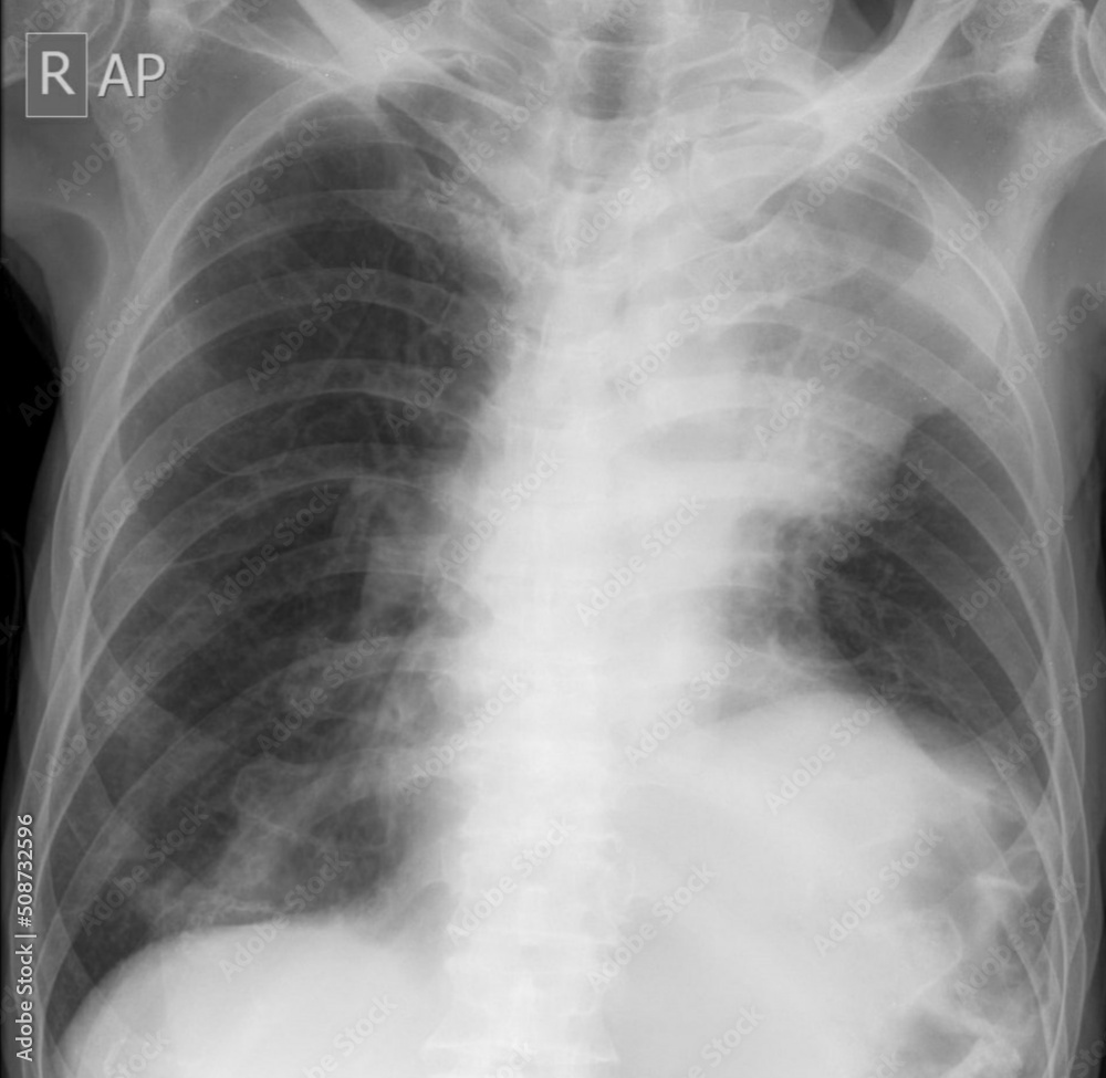 Golden’s S Sign, Reverse S Sign of Golden, chest x-ray Golden’s S Sign, Reverse S Sign of Golden, chest x-ray