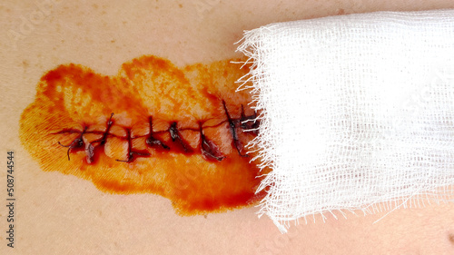 Medical sutures, stitch after surgery, stitched surgical sutures on human body smeared betadine.