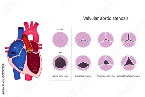 Valvular aortic stenosis. Normal aortic valve, Bicuspid aortic valve, Rheumatic aortic valve and Calcified trileaflet aortic valve. photo