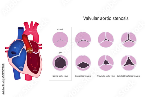 Valvular aortic stenosis. Normal aortic valve, Bicuspid aortic valve, Rheumatic aortic valve and Calcified trileaflet aortic valve.