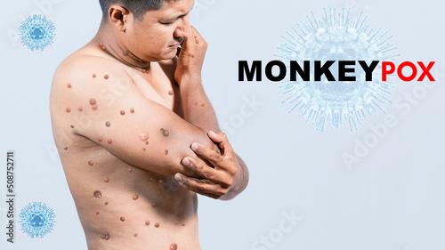 A person with monkeypox on his body, People with monkeypox on isolated background, monkeypox virus concept, monkeypox virus outbreak pandemic design photo