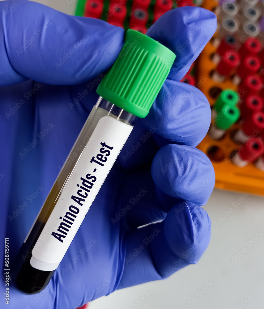 Blood sample for Amino acids profile test, Amino Acids Analysis. Stock