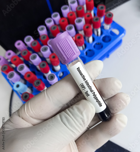 Blood sample for Vasoactive Intestinal Polypeptide(VIP) Test, suggestive of secreting neuro-endocrine tumour or multiple endocrine neoplasia type 1, Gut hormone test.