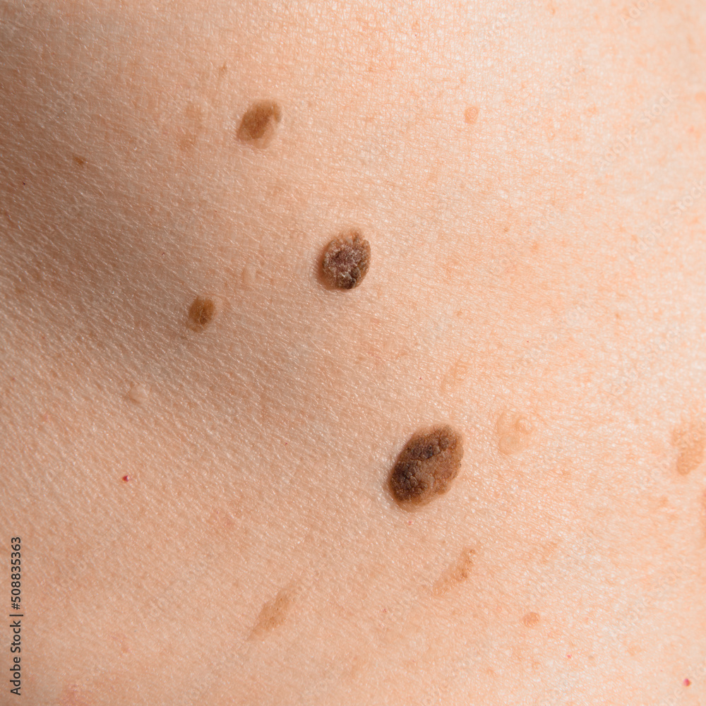 Skin mole on human body. Brown nevi or nevus on back skin. Check moles concept. Closeup.
