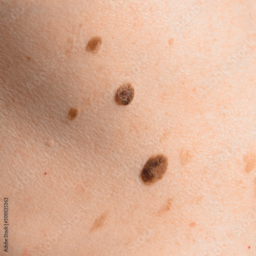 Skin mole on human body. Brown nevi or nevus on back skin. Check moles concept. Closeup. photo