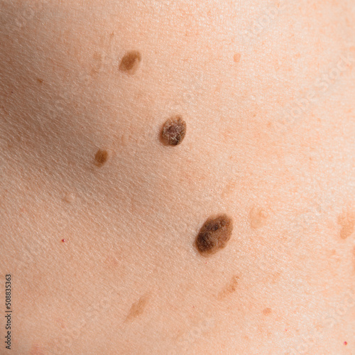 Obraz na płótnie Skin mole on human body. Brown nevi or nevus on back skin. Check moles concept. Closeup. w salonie