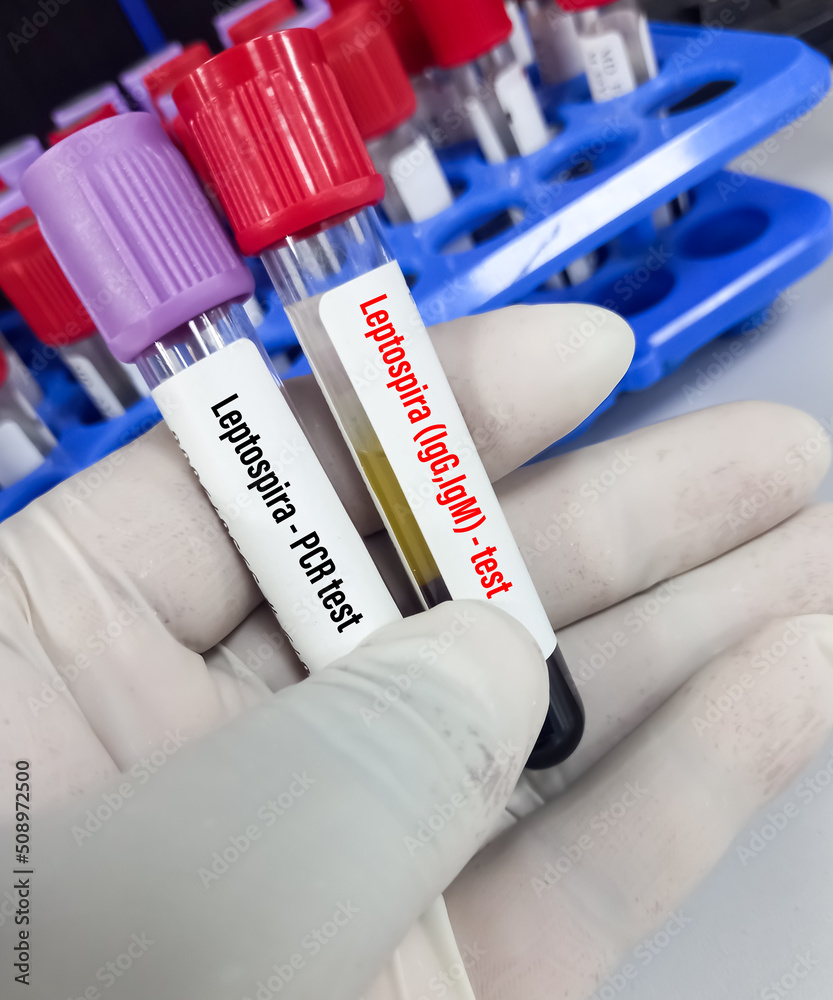Blood sample for Leptospira Test to identify Leptospirosis caused by Blood sample for Leptospira Test to identify Leptospirosis caused by