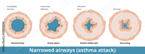 Stages of airways narrowing during asthma attack with possible formation of mucus plug. Smooth muscle layer goes into spasm, middle layer swells, excessive mucus is produced.