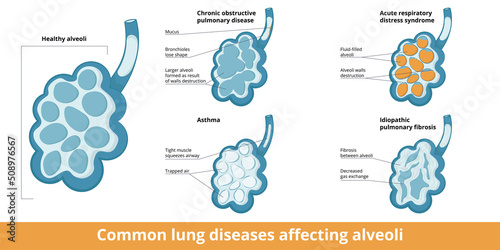 Common alveoli damages. Differences between changes caused by lung diseases: chronic obstructive respiratory disease, asthma, acute respiratory distress syndrome and idiopathic pulmonary fibrosis.