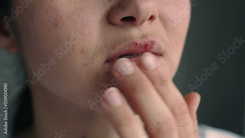 Part of the face of a young woman with lips affected by herpes.