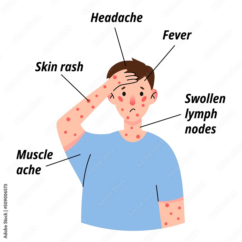monkeypox-virus-symptom-infographic-on-patient-with-fever-headache
