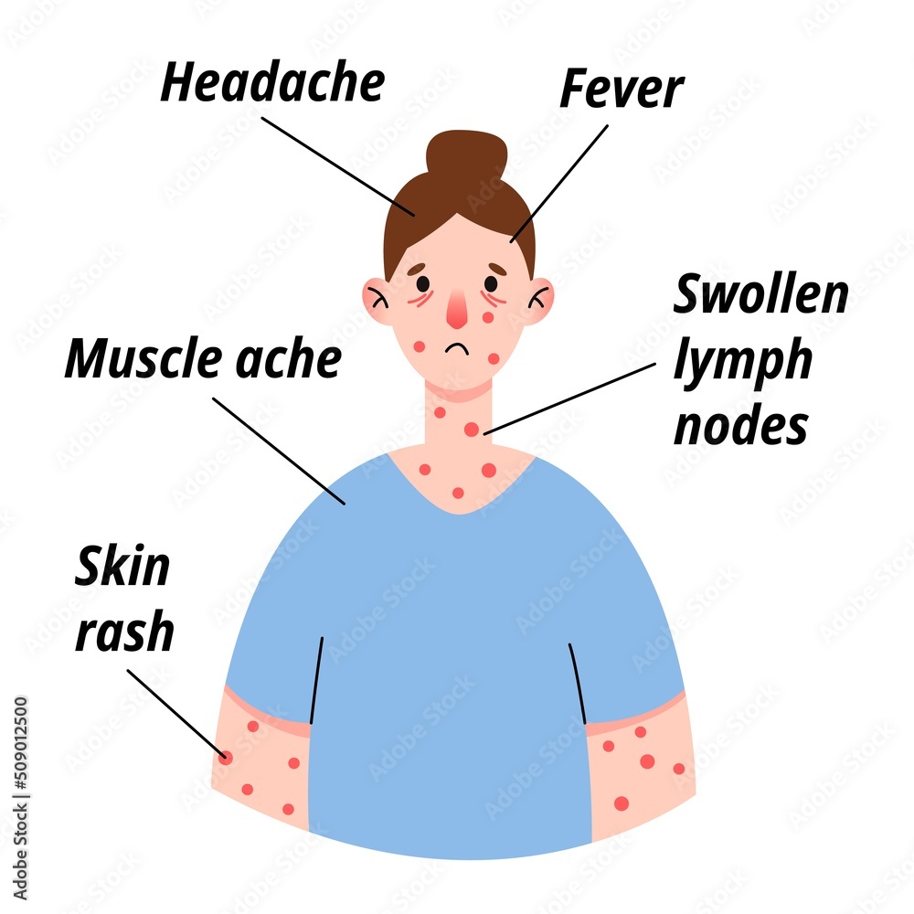 monkeypox-virus-symptom-infographic-on-woman-patient-with-fever