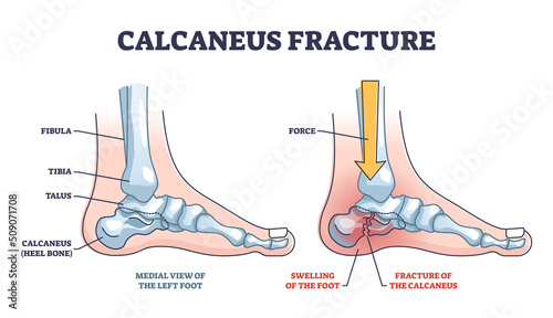 Fotografiet Calcaneus fracture anatomy with broken heel bone structure outline diagram