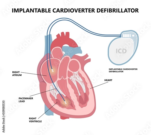 Pacemaker ICD Implantable Cardioverte Defibrillator Pulse Generator Stimulate of Heart Prevent Bradycardia Electronic Medical Device photo