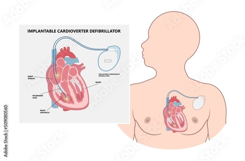 Pacemaker ICD Implantable Cardioverte Defibrillator Pulse Generator Stimulate of Heart Prevent Bradycardia Electronic Medical Device