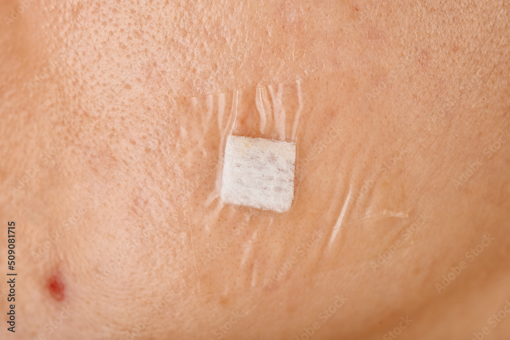 Wound care, Acne treatment, Facial scar wound dressing with sterile pad film.