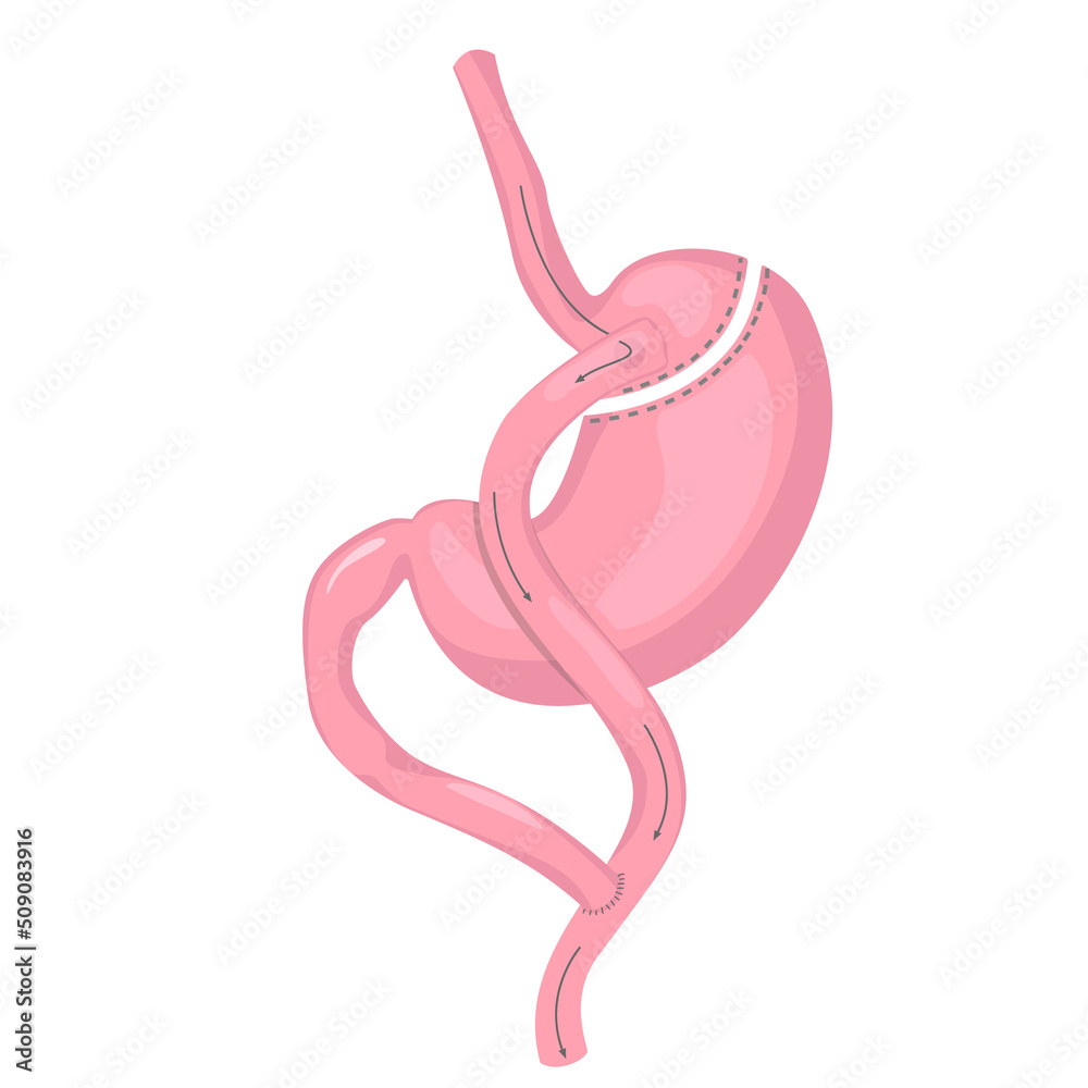 Gastric bypass of stomach. Methods of weight loss surgery. Bariatry. Human anatomy illustration for infographics, atlas, textbook or study material. - obrazy, fototapety, plakaty 