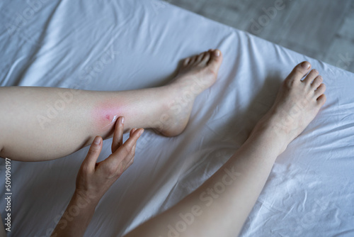 Woman touches her leg after being bitten by mosquito or bedbug in hotel, suffering from allergic reaction and swelling, experiencing pain. Skin reaction to blood-sucking insects. Allergy. 