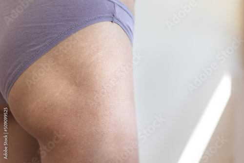 Female body with stretch marks on the buttocks photo