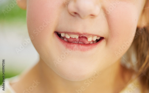 A little girl lost her baby milk tooth. Lost temporary tooth. The concept of oral hygiene in children. Close-up of the oral cavity.