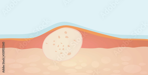 Acne structure on skin. vector