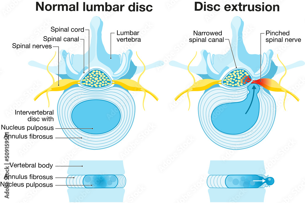 Normal Disc Bulge Protrusion Extrusion Sequestration Herniated Disc Schema Blue Design