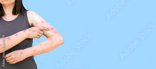 Monkeypox new disease dangerous over the world. Patient with Monkey Pox. Painful rash, red spots blisters on the hand. Close up rash, human hands with Health problem. Banner, copy space photo