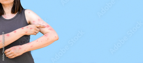 Monkeypox new disease dangerous over the world. Patient with Monkey Pox. Painful rash, red spots blisters on the hand. Close up rash, human hands with Health problem. Banner, copy space