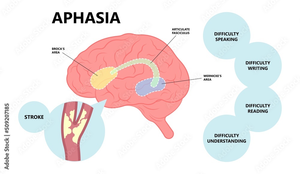 Aphasia Brain Damage Stroke Ischemia Fatty Clots Artery Leaking Attack ...