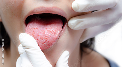 Tongue of a young Caucasian woman with benign migratory glossitis, held by a doctor wearing white gloves. Tongue with candidiasis. Cracks in the tongue. photo