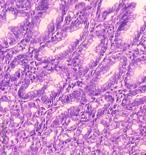 Resected lower part of stomach(biopsy): Lymph node show reactive change, Gastric biopsies,Stomach cancer.  photo