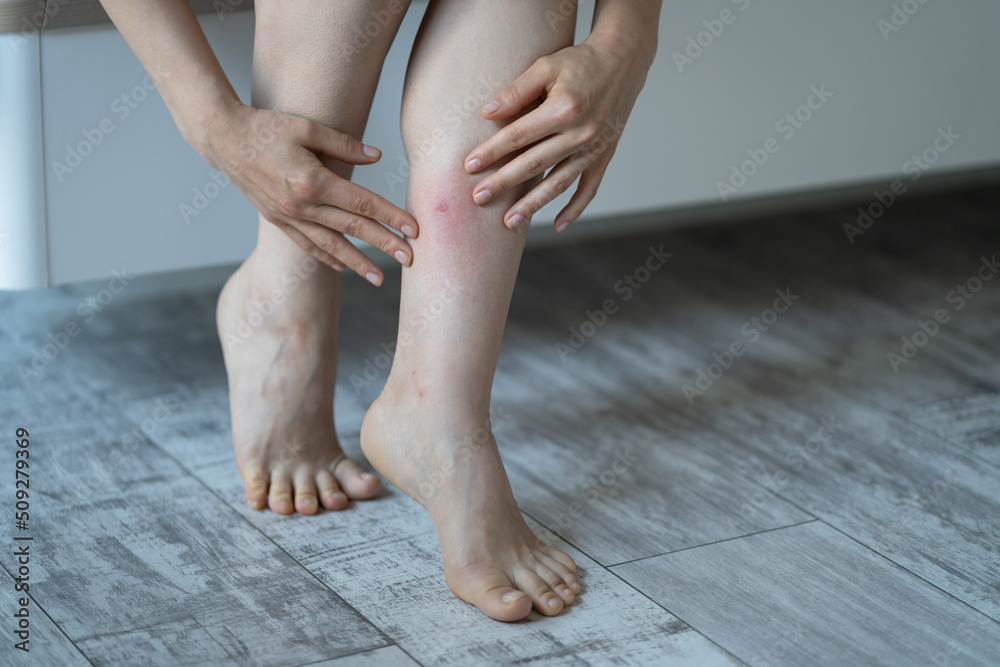 Woman touches her leg after being bitten by mosquito or flea in hotel ...