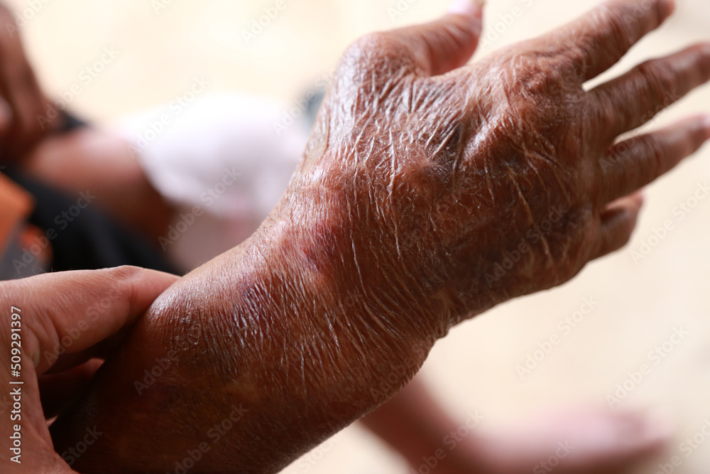 Skin disorder, pepper appearance from scleroderma, autoimmune disease