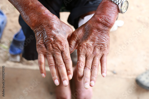 Skin disorder, pepper appearance from scleroderma, autoimmune disease male hand Skin disorder pepper appearance from vitiligo,scleroderma raynaud, medical concept autoimmune disease. Skin disorder,