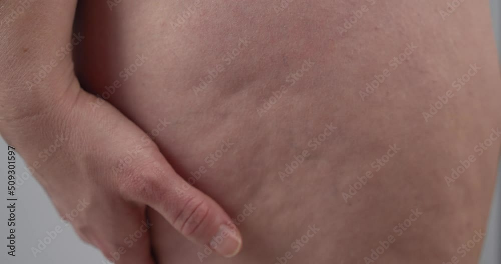 Female Hand Massaging Thigh With Cellulite. Self-massage. close up Female Hand Massaging Thigh With Cellulite. Self-massage. close up