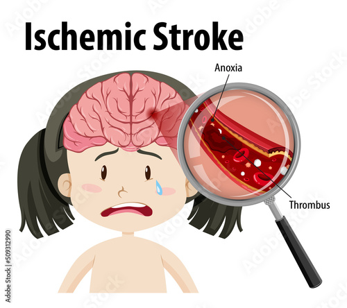 Human with Ischemic stroke
