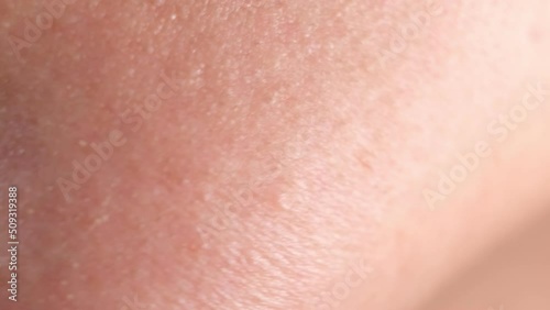 Human skin. Close up. common skin diseases include: Acne, blocked skin follicles that lead to oil, bacteria and dead skin buildup in your pores.