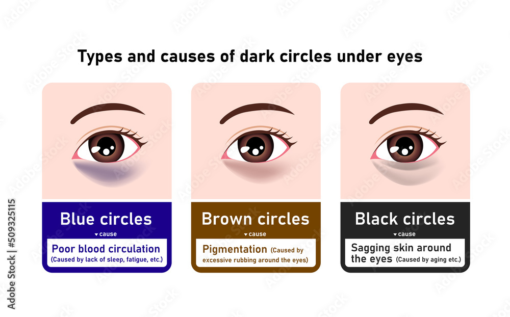 Types And Causes Of Dark Circles Under Eyes Vector Illustration Stock