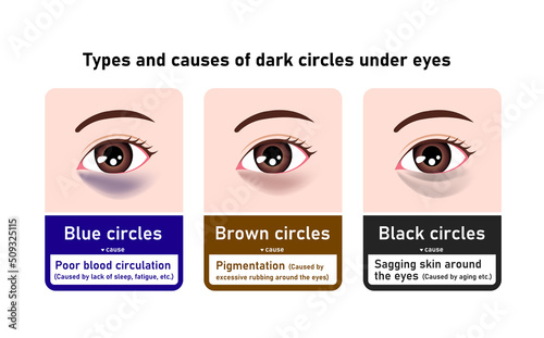 Types and causes of dark circles under eyes. Vector illustration