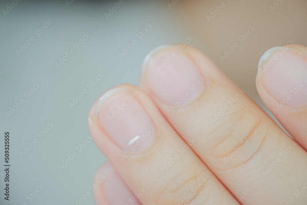 White spots on finger nails called leukonychia reveal the emergence of health problems. Stock