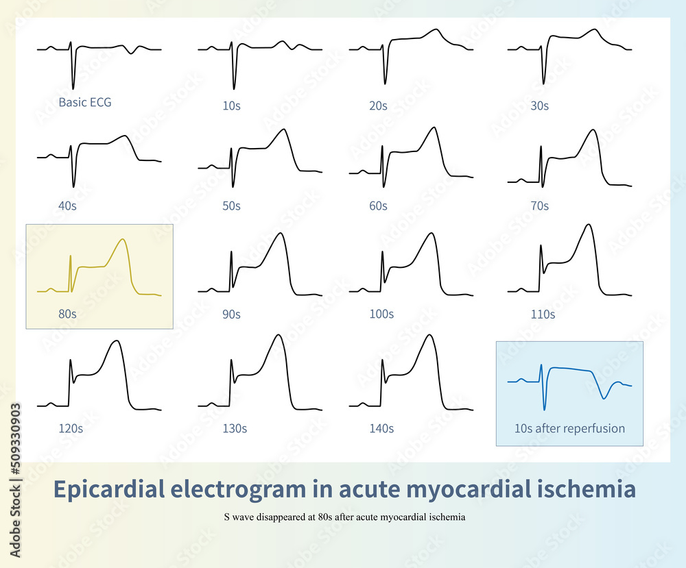 Naklejka premium The epicardial electrogram of acute myocardial ischemia was recorded by ligating the left anterior descending branch of the pig. Note T wave inversion during reperfusion.