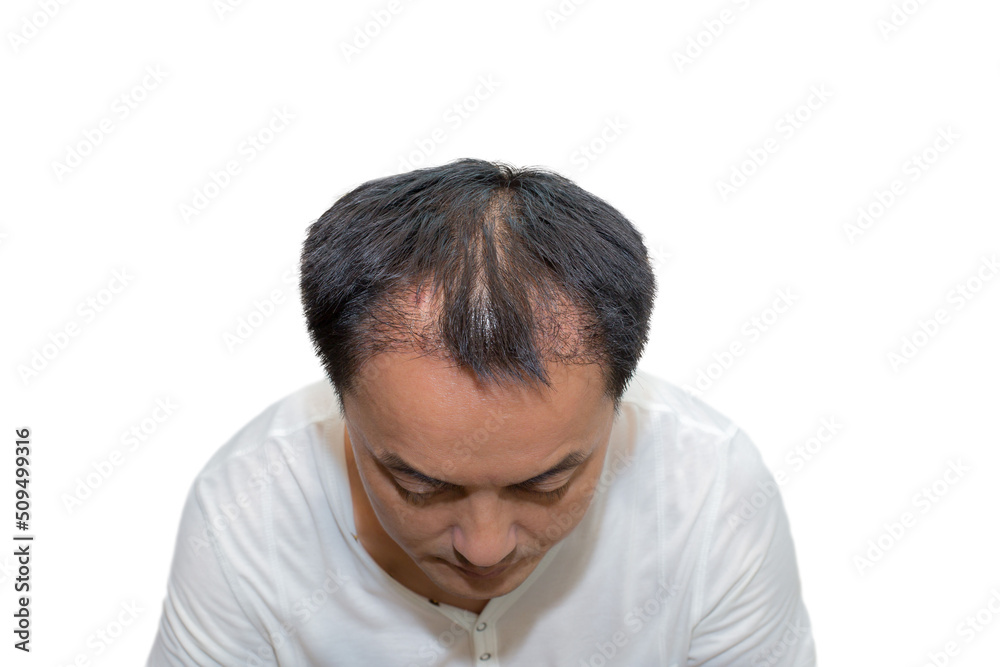 Close up top view of a man's head with hair transplant surgery with a receding hair line. - 5 months after Bald head of hair loss treatment. Close up top view of a man's head with hair transplant surgery with a receding hair line. - 5 months after Bald head of hair loss treatment.