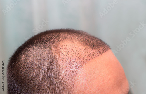 Foto Top view of a man's head with hair transplant surgery with a receding hair line
