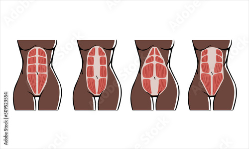 Different types of Diastasis on non-Caucasian skin. Diastasis in a woman after pregnancy and childbirth. Woman anatomy. 
Muscle corset of a woman after childbirth. Vector illustration