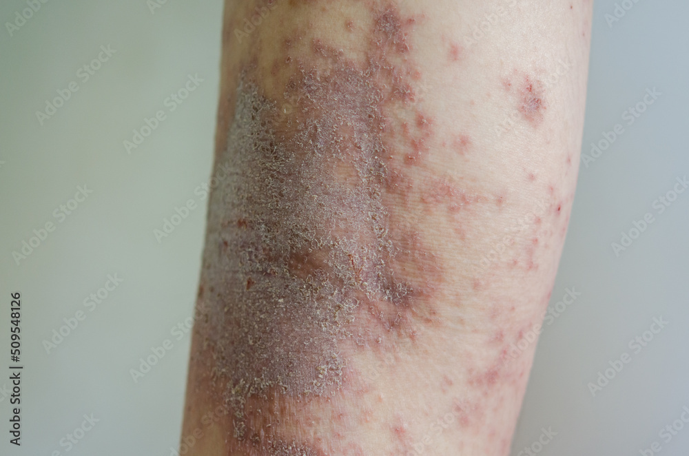 red rash girl Skin disease caused by allergies to drugs, food ...