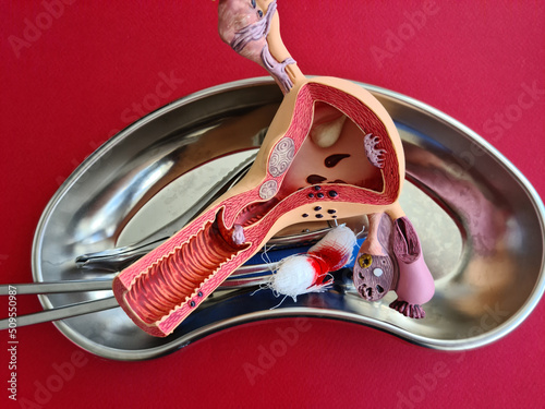 Surgery of genital organs of uterus and ovaries in women. Model of uterus and ovaries next to scalpel and blood result photo