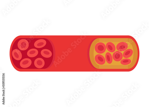 Change of vessel from normal to cholesterol-blocked artery. Blood clot, thrombus, atherosclerotic plaque. Deep vein thrombosis DVT or arterial clot, blood vascular flow. Blocked circulation. Vector