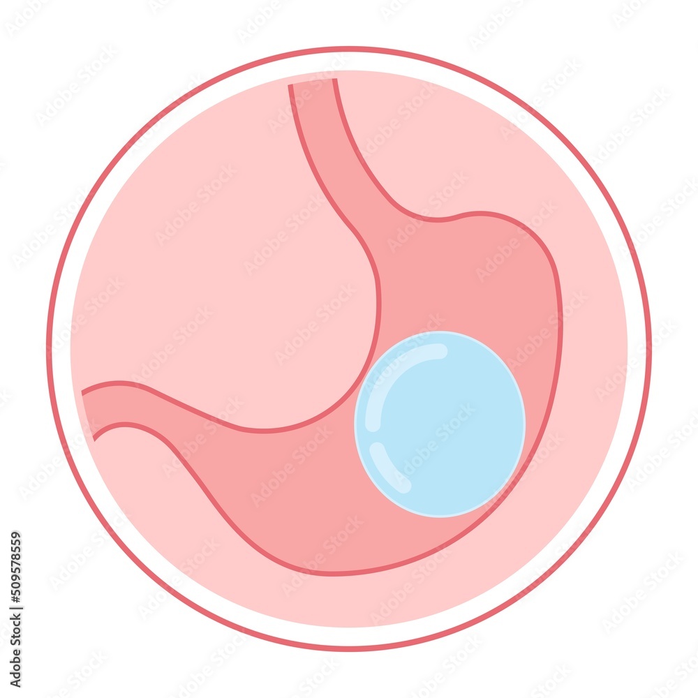 Gastric bypass surgery and Band roux en y procedure endoscopy weight